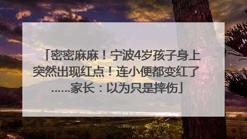 密密麻麻！宁波4岁孩子身上突然出现红点！连小便都变红了……家长：以为只是摔伤